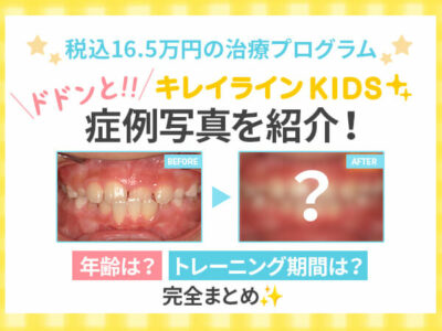 キレイラインKIDSの症例写真を紹介