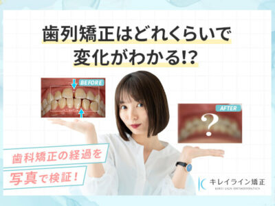 歯科矯正はどれくらいで変化がわかる？